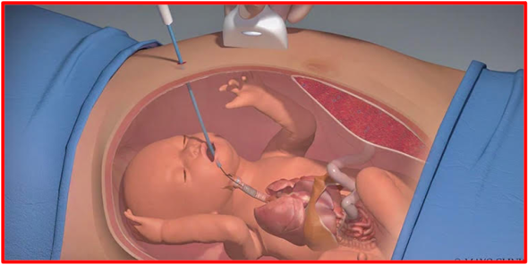 Chirurgie intra-utérine des fœtus à risque. Un périnatologiste ou un spécialiste en chirurgie materno-fœtale effectuant une intervention chirurgicale sur un bébé à naître (fœtus) pour aider à améliorer les résultats à long terme d'un enfant présentant des malformations congénitales spécifiques. Nos facultés intellectuelles extrêmes semblent simultanément nous informer que nous sommes à la fois éternels quand nous sommes vivants et que nous ne le sommes pas du tout puisque la mort est irréversible. L'énigme existentielle et non-existentielle de l'humain crée chez l’Homme un vide profond et par ricochet, un sentiment d’être déboussolé et d'angoisse aiguë. The Bridge MAG. Image 