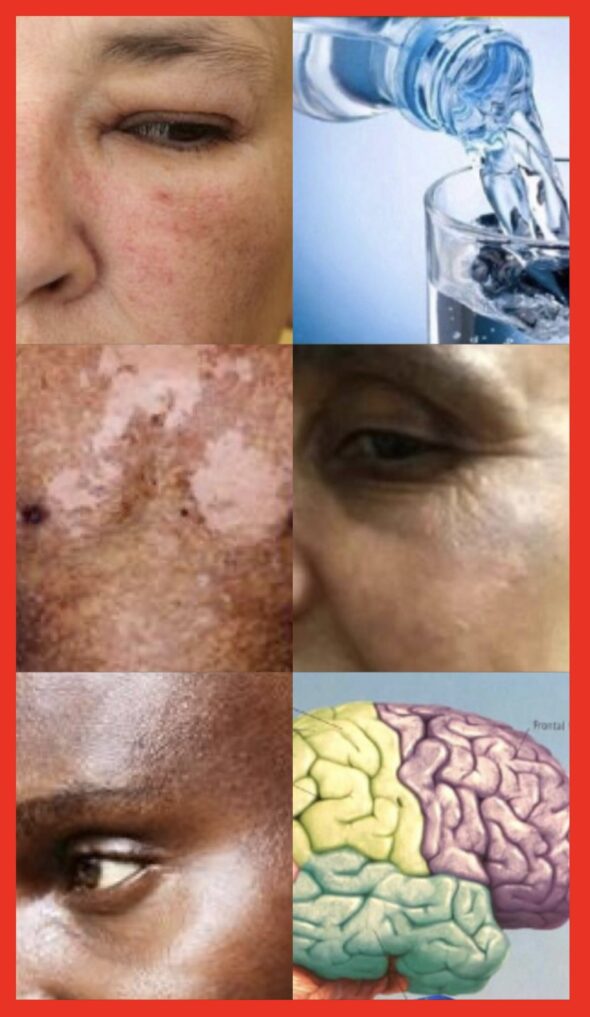 Even the weather seems to plot against mankind's skin health. The number of people exposed to extreme heat is growing at a rapid pace due to global warming.Heatstroke is to cause skin conditions such as: heat rash, eczema, rosacea, the discoloration of melasma (Hyperpigmentation disorders). Heatstroke is a medical emergency with a high-case fatality rate. Heat-related mortality for people over 65 years of age increased by approximately 85%, statistics revealed. Without a quick response to lower the body temperature such as: air conditioning, drinking water, heatstroke can cause the brain or other vital organs to swell, possibly resulting in permanent damage. The Bridge MAG. Image